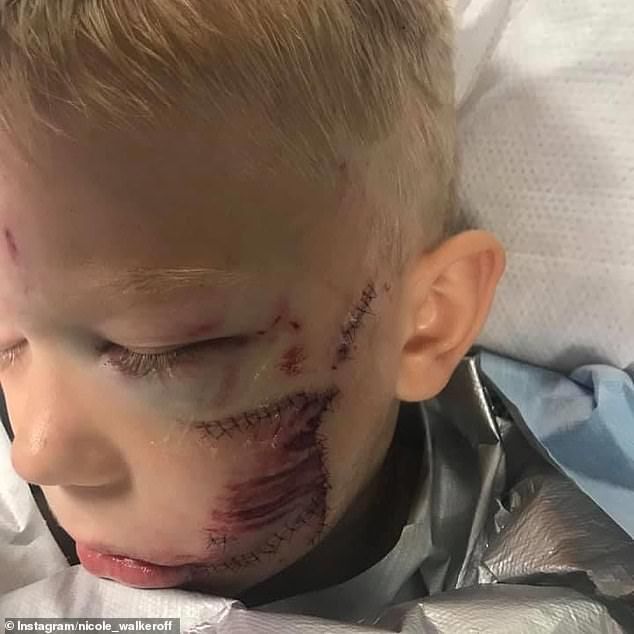 الطفل بريدجر بعد تعرضه للإصابة خلال انقاذ شقيقته من هجوم كلب instagram.com/nicolenoelwalke