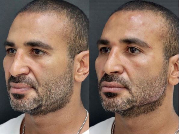 مشاهير غيرت عمليات التجميل ملامحهم وحياتهم