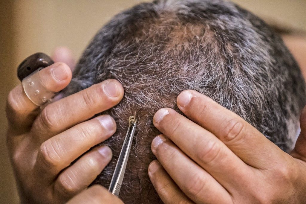 العلاج بلسعات النحل في الجيزة