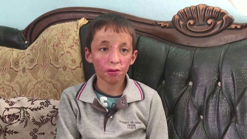 شيبلي عمر.. طفل مشوه في الحرب السورية يكافح من أجل حياة جديدة 1 طفل