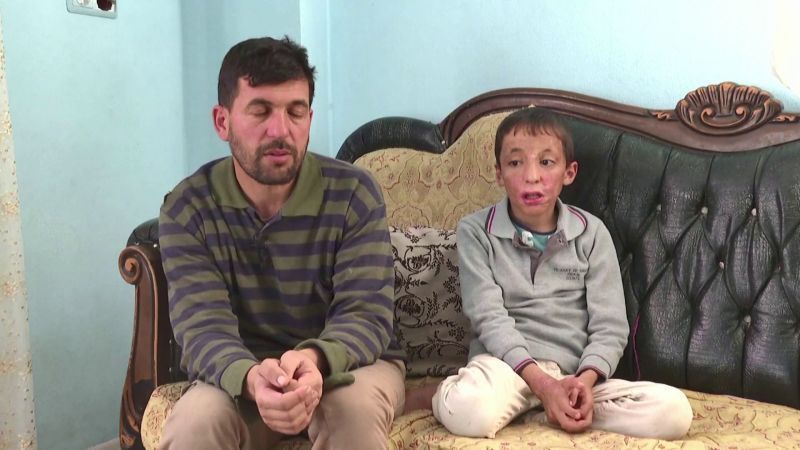 شيبلي عمر.. طفل مشوه في الحرب السورية يكافح من أجل حياة جديدة 2 طفل