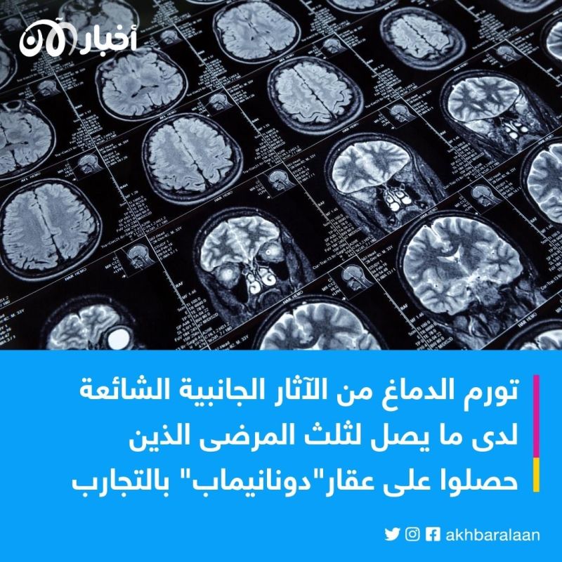 "دونانيماب".. علاج يثبت فاعليته في إبطاء تطور ألزهايمر 2 "دونانيماب".. علاج يثبت فاعليته في إبطاء تطور ألزهايمر